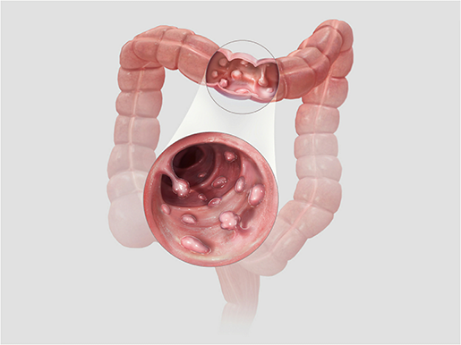 Physiology & Pathology: 5 Common Gastrointestinal Conditions